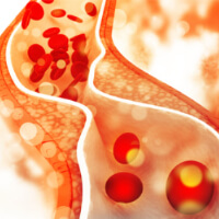 Arteriosklerose ist die häufigste Ursache für Durchblutungsstörungen. Oxyvenierung nach Dr. Regelsberger kann hier helfen.